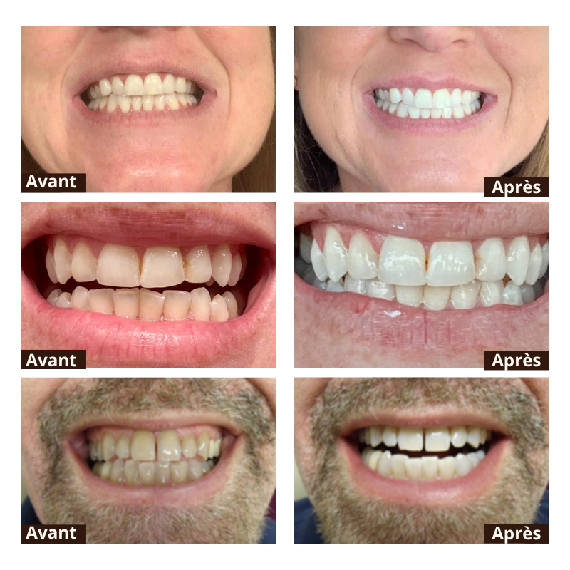 BodyAccel™ – Dents plus blanches en 7 jours